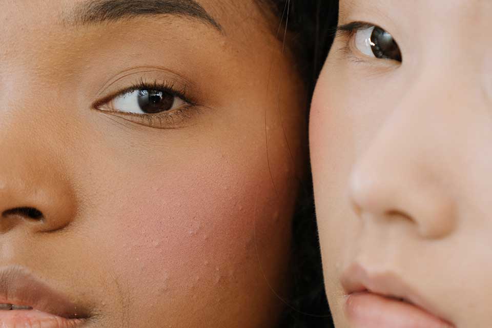 Cómo eliminar los brotes de acné en el rostro